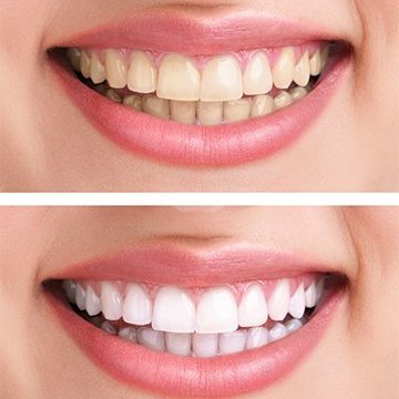 Kosmetisches Zahnbleaching - Johanna Kratzer - Beauty Time ...